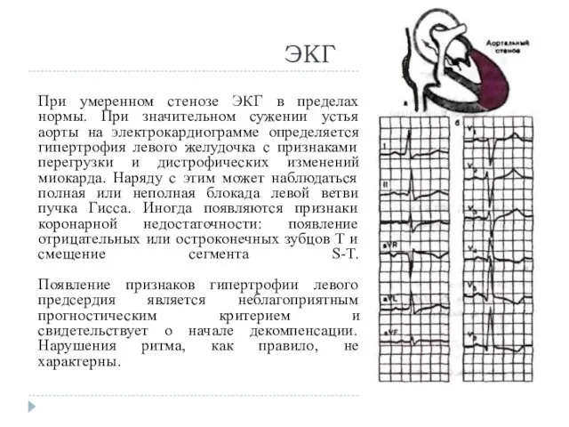 ЭКГ При умеренном стенозе ЭКГ в пределах нормы. При значительном