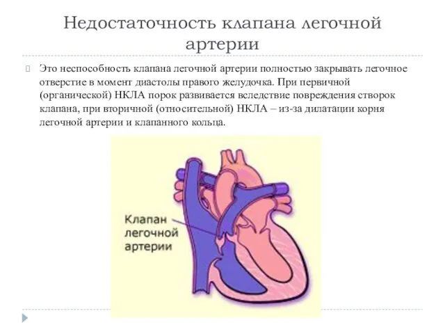 Недостаточность клапана легочной артерии Это неспособность клапана легочной артерии полностью