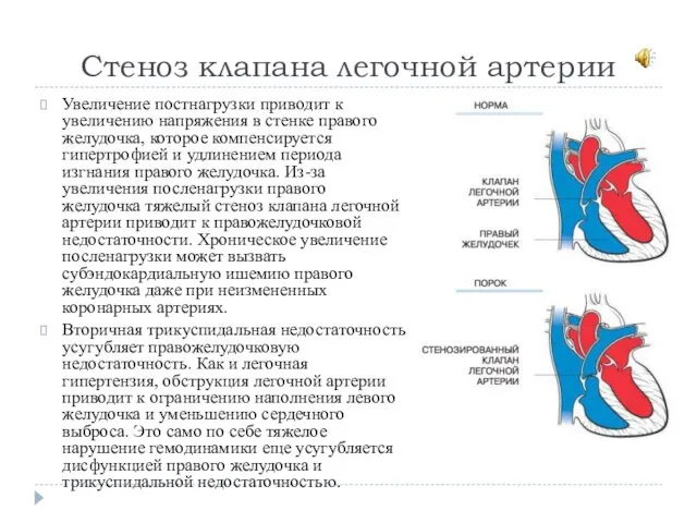 Стеноз клапана легочной артерии Увеличение постнагрузки приводит к увеличению напряжения