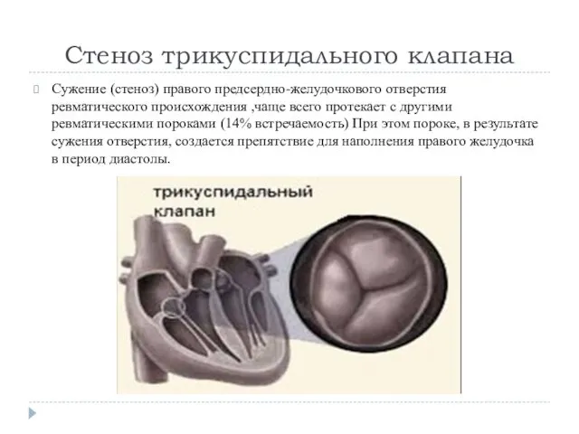 Стеноз трикуспидального клапана Сужение (стеноз) правого предсердно-желудочкового отверстия ревматического происхождения