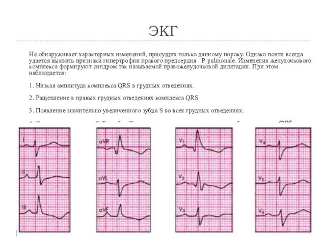 ЭКГ Не обнаруживает характерных изменений, присущих только данному пороку. Однако