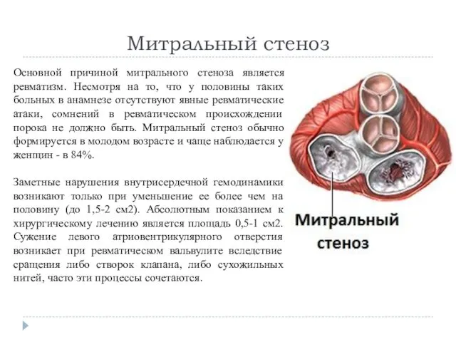 Митральный стеноз Основной причиной митрального стеноза является ревматизм. Несмотря на