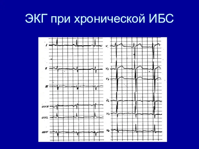 ЭКГ при хронической ИБС