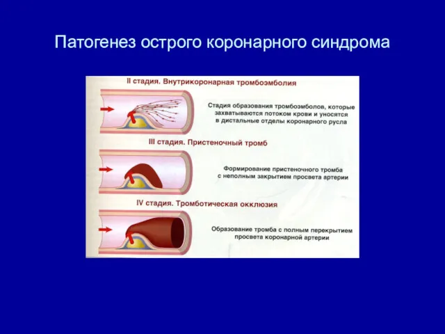 Патогенез острого коронарного синдрома