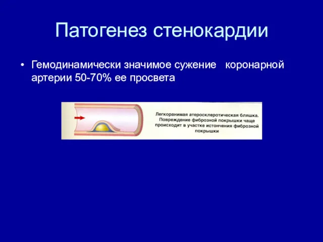 Патогенез стенокардии Гемодинамически значимое сужение коронарной артерии 50-70% ее просвета