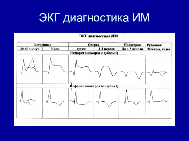 ЭКГ диагностика ИМ