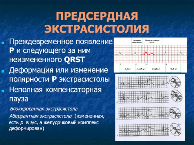 ПРЕДСЕРДНАЯ ЭКСТРАСИСТОЛИЯ Преждевременное появление Р и следующего за ним неизмененного QRSТ Деформация или