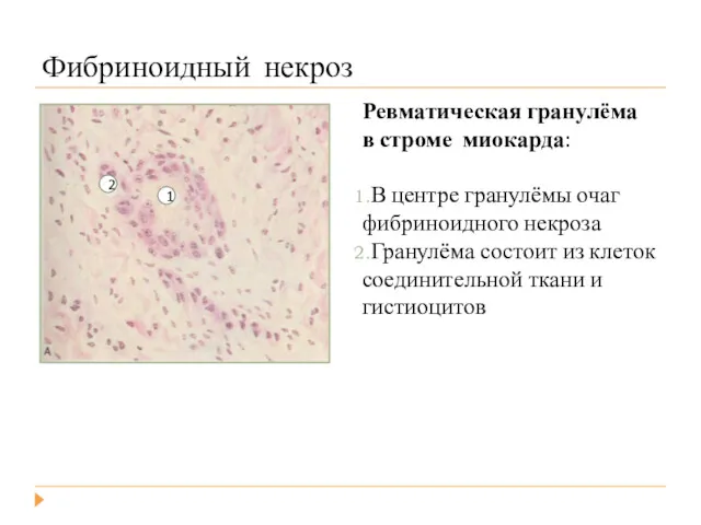 Фибриноидный некроз Ревматическая гранулёма в строме миокарда: В центре гранулёмы