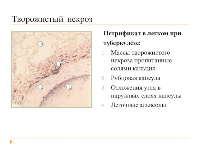 Творожистый некроз Петрификат в легком при туберкулёзе: Массы творожистого некроза