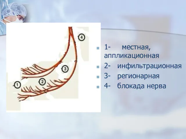 1- местная, аппликационная 2- инфильтрационная 3- регионарная 4- блокада нерва