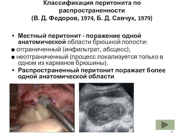 Классификация перитонита по распространенности (В. Д. Федоров, 1974, Б. Д.
