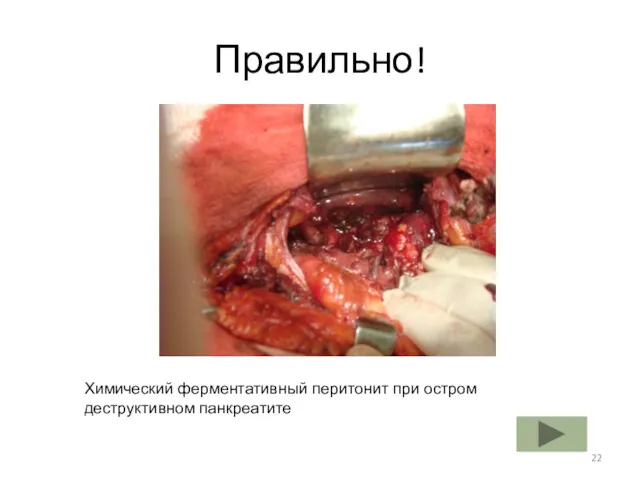 Правильно! Химический ферментативный перитонит при остром деструктивном панкреатите