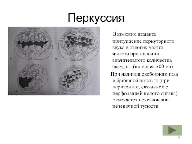 Перкуссия Возможно выявить притупление перкуторного звука в отлогих частях живота