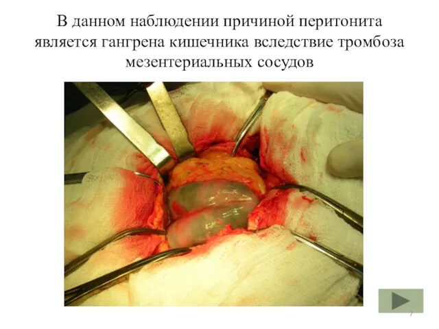 В данном наблюдении причиной перитонита является гангрена кишечника вследствие тромбоза мезентериальных сосудов