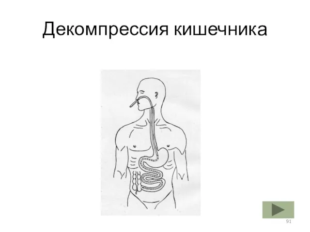 Декомпрессия кишечника