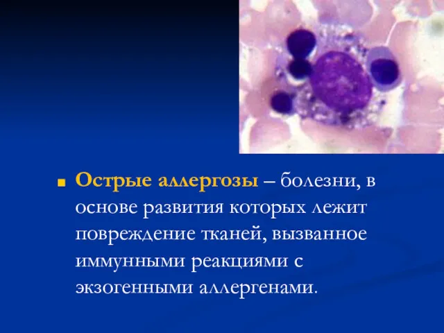 Острые аллергозы – болезни, в основе развития которых лежит повреждение