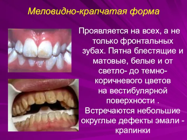 Меловидно-крапчатая форма Проявляется на всех, а не только фронтальных зубах.