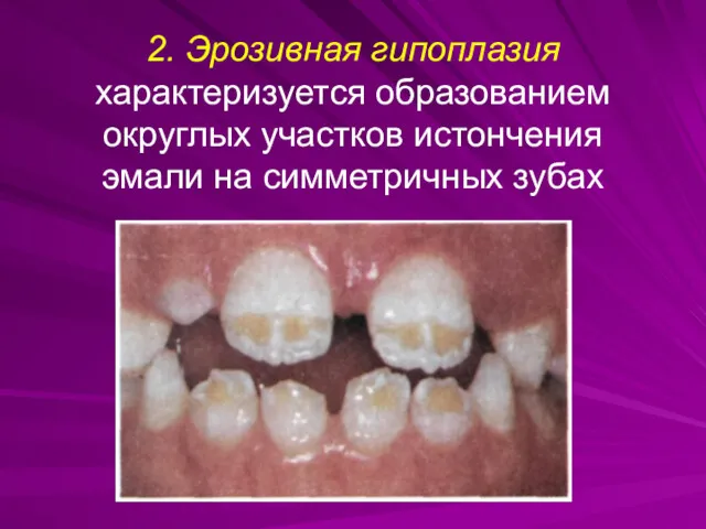 2. Эрозивная гипоплазия характеризуется образованием округлых участков истончения эмали на симметричных зубах