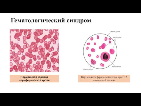 Гематологический синдром Нормальная картина периферической крови Картина периферической крови при В12 дефицитной анемии