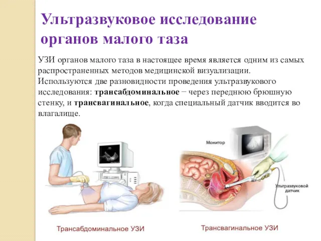 Ультразвуковое исследование органов малого таза УЗИ органов малого таза в