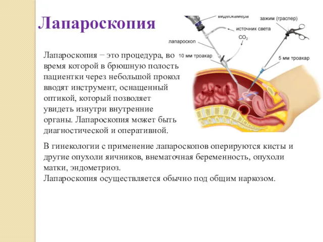 Лапароскопия Лапароскопия − это процедура, во время которой в брюшную