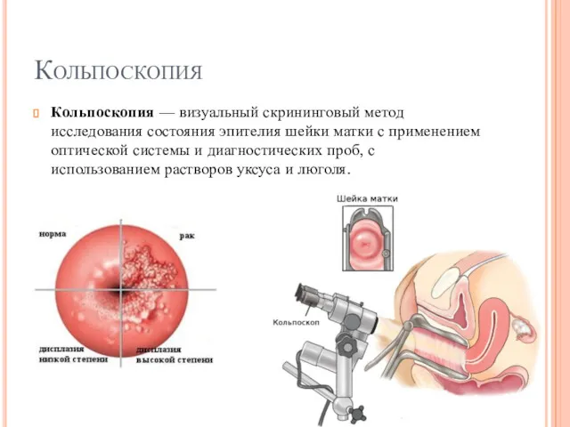 Кольпоскопия Кольпоскопия — визуальный скрининговый метод исследования состояния эпителия шейки