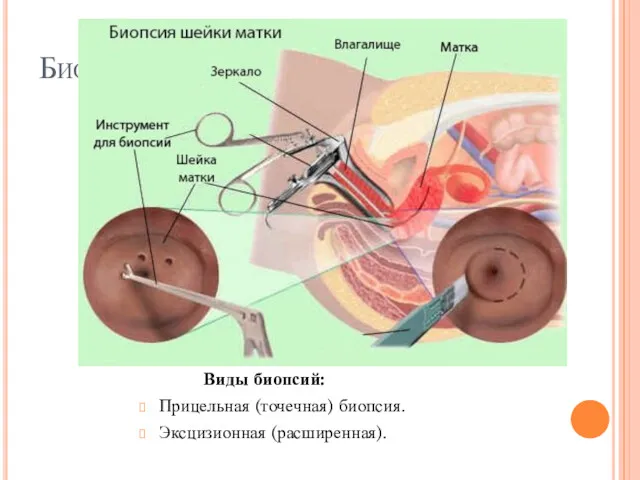 Биопсия шейки матки Виды биопсий: Прицельная (точечная) биопсия. Эксцизионная (расширенная).
