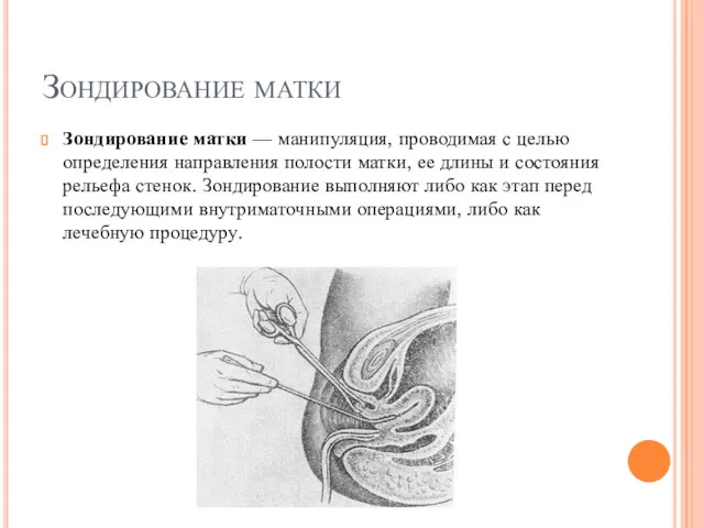 Зондирование матки Зондирование матки — манипуляция, проводимая с целью определения