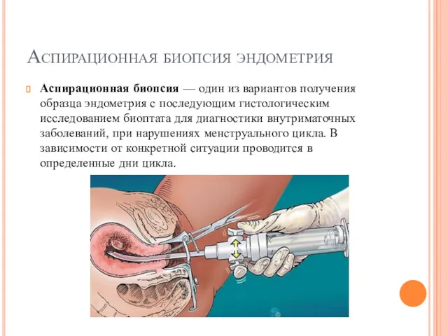 Аспирационная биопсия эндометрия Аспирационная биопсия — один из вариантов получения