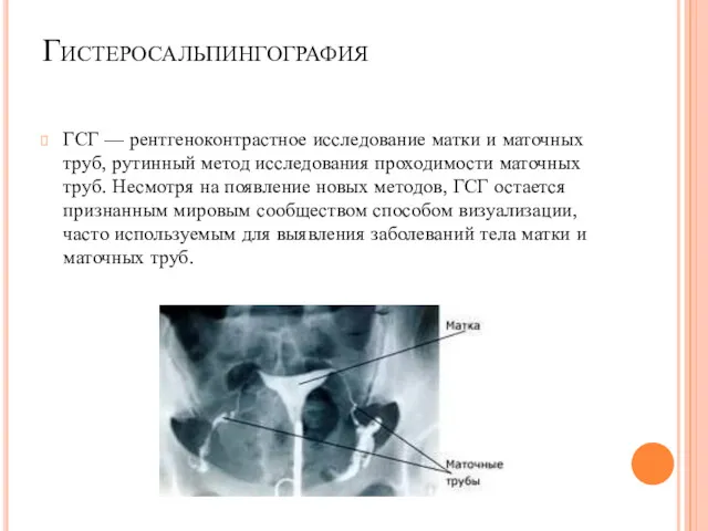 Гистеросальпингография ГСГ — рентгеноконтрастное исследование матки и маточных труб, рутинный