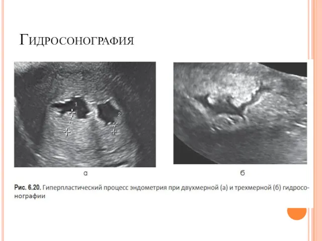 Гидросонография