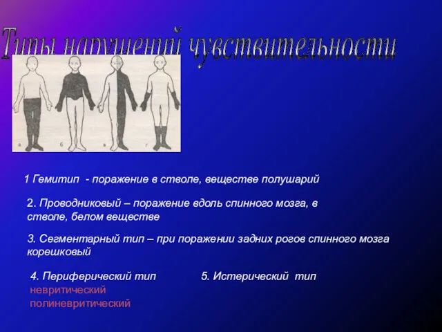 Типы нарушений чувствительности 2. Проводниковый – поражение вдоль спинного мозга,