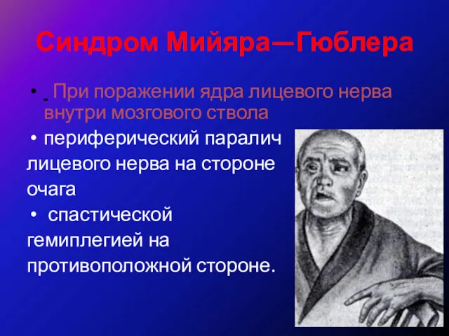 Синдром Мийяра—Гюблера При поражении ядра лицевого нерва внутри мозгового ствола