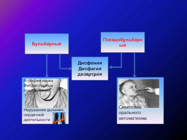 Псевдобульбарный паралич Псевдобульбарный Дисфония Дисфагия дизартрия Нарушения дыхания, сердечной деятельности