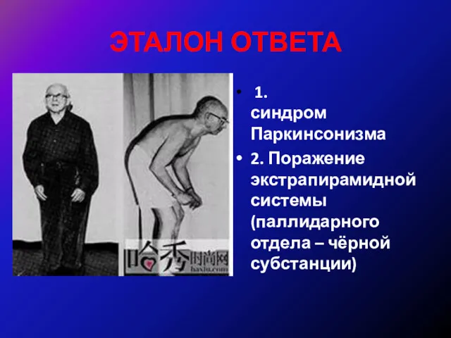 ЭТАЛОН ОТВЕТА 1. синдром Паркинсонизма 2. Поражение экстрапирамидной системы (паллидарного отдела – чёрной субстанции)