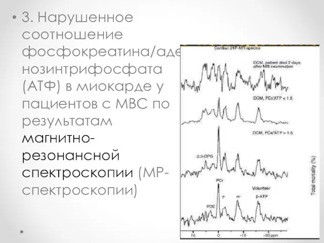 3. Нарушенное соотношение фосфокреатина/аденозинтрифосфата (АТФ) в миокарде у пациентов с МВС по результатам магнитно-резонансной спектроскопии (МР-спектроскопии)