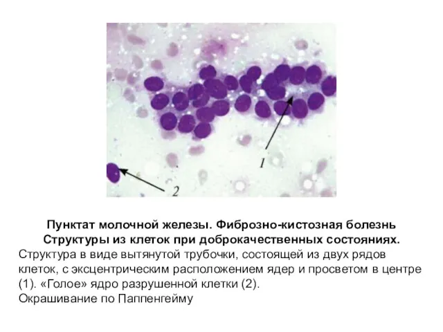 Пунктат молочной железы. Фиброзно-кистозная болезнь Структуры из клеток при доброкачественных