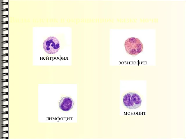 нейтрофил эозинофил моноцит лимфоцит Виды клеток в окрашенном мазке мочи