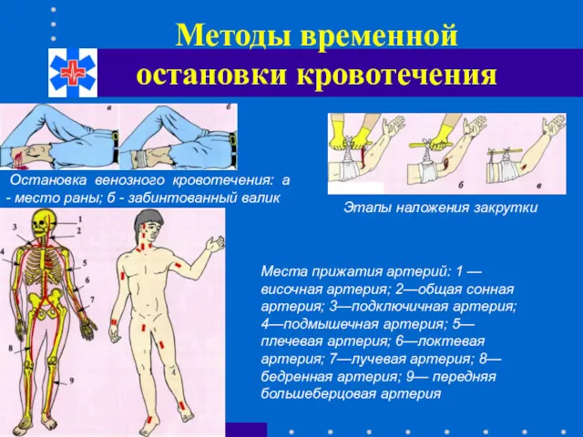 Методы временной остановки кровотечения Остановка венозного кровотечения: а - место