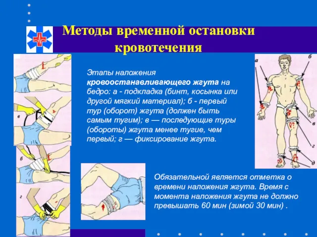 Методы временной остановки кровотечения Этапы наложения кровоостанавливающего жгута на бедро: