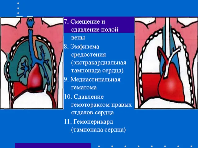 7. Смещение и сдавление полой вены 8. Эмфизема средостения (экстракардиальная
