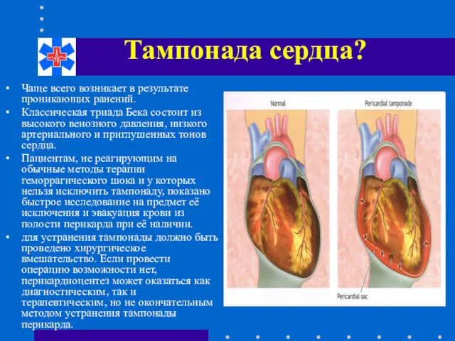 Тампонада сердца? Чаще всего возникает в результате проникающих ранений. Классическая