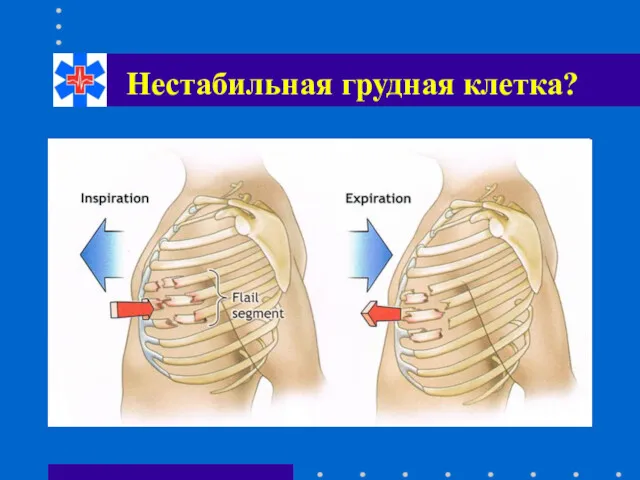 Нестабильная грудная клетка?