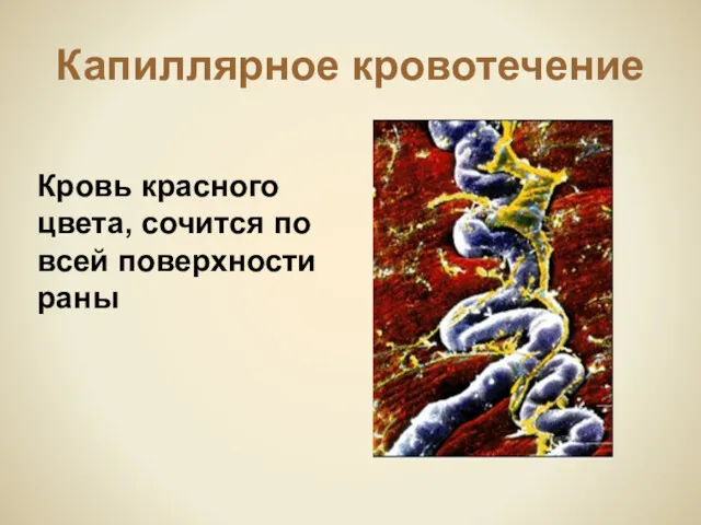 Капиллярное кровотечение Кровь красного цвета, сочится по всей поверхности раны