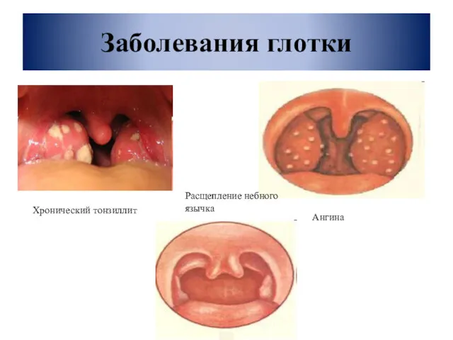 Заболевания глотки Хронический тонзиллит Ангина Расщепление небного язычка
