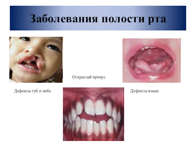 Заболевания полости рта Дефекты губ и неба Дефекты языка Открытый прикус