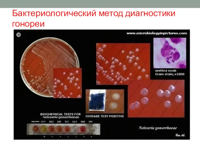 Бактериологический метод диагностики гонореи