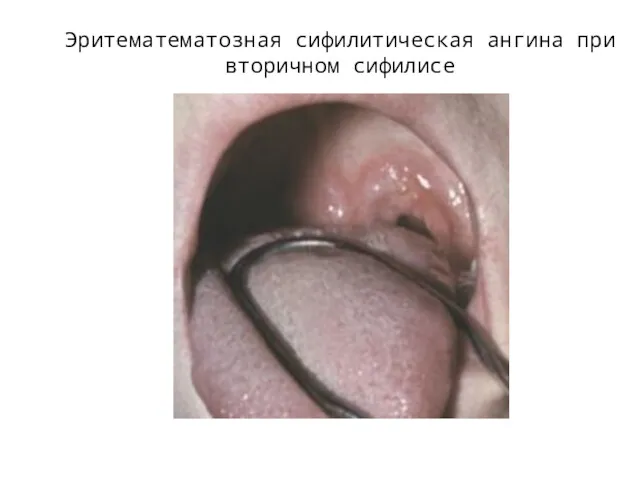 Эритематематозная сифилитическая ангина при вторичном сифилисе