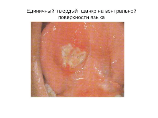 Единичный твердый шанкр на вентральной поверхности языка