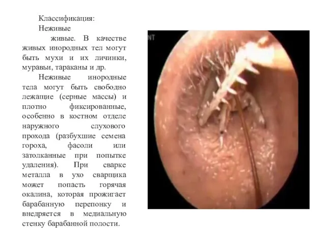 Классификация: Неживые живые. В качестве живых инородных тел могут быть